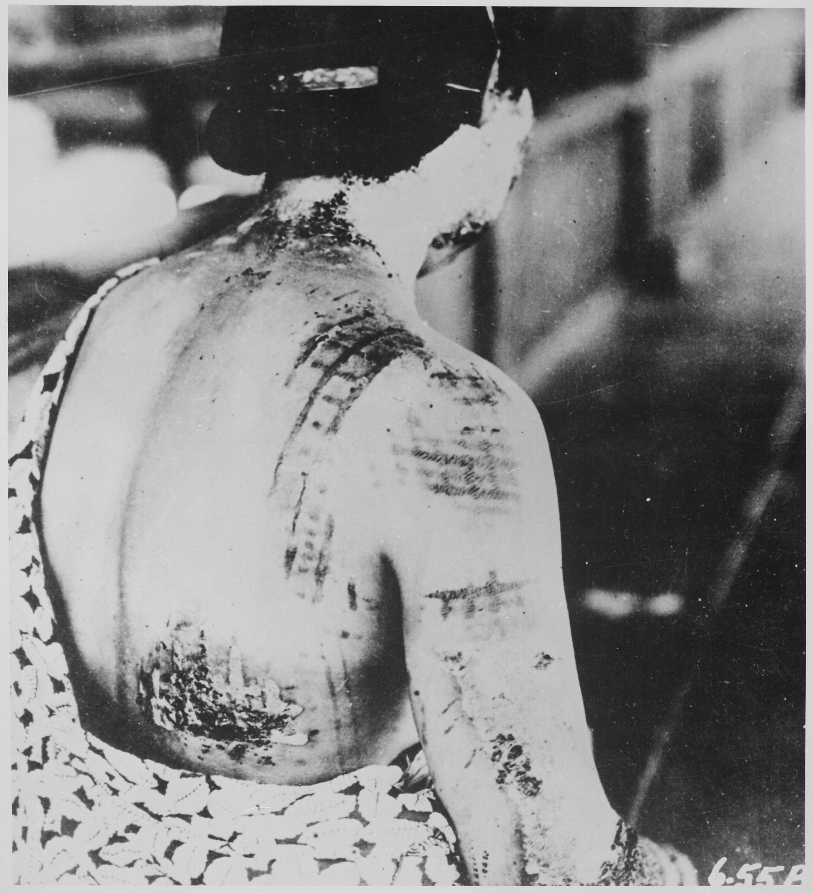 广岛一位女性展示背部——爆炸时和服图案被烧灼在皮肤上，1945年