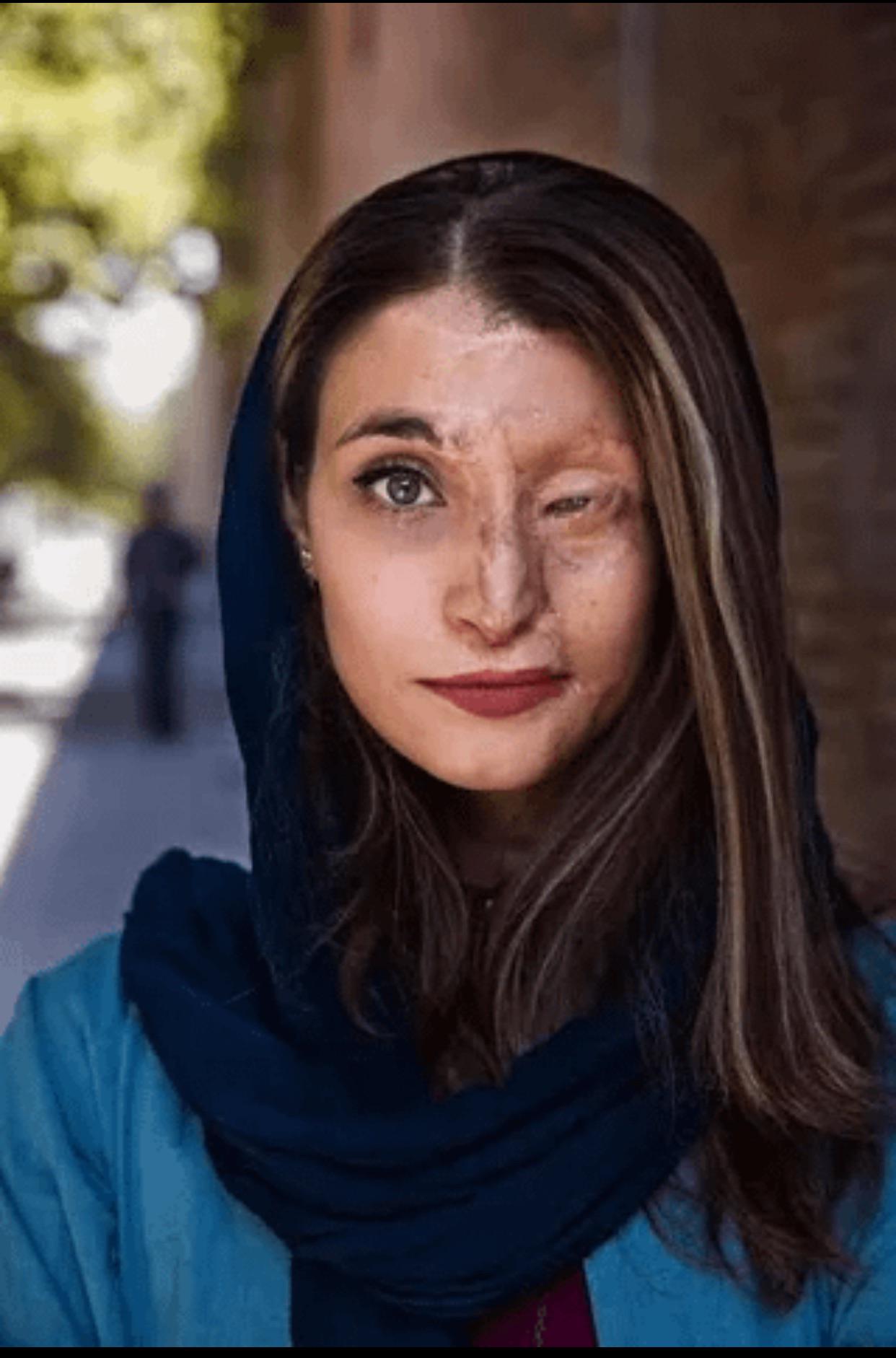 2014年，玛齐·埃布拉希米（Marzieh Ebrahimi）在伊朗的一起泼酸袭击中失去了一只眼睛。然而，这从未磨灭她领导伊朗抗议活动并勇敢反抗政权的意志！
