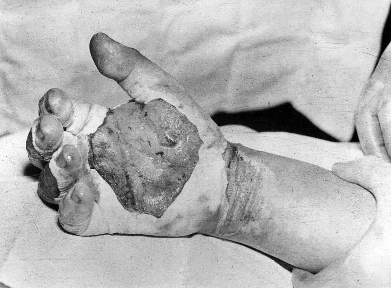 美国物理学家哈里·达格利安的辐射烧伤右手，1945年8月30日